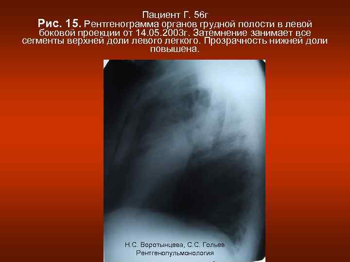 Пациент Г. 56 г Рис. 15. Рентгенограмма органов грудной полости в левой боковой проекции