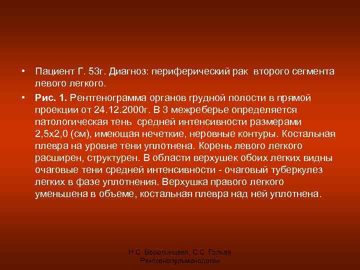  • Пациент Г. 53 г. Диагноз: периферический рак второго сегмента левого легкого. •