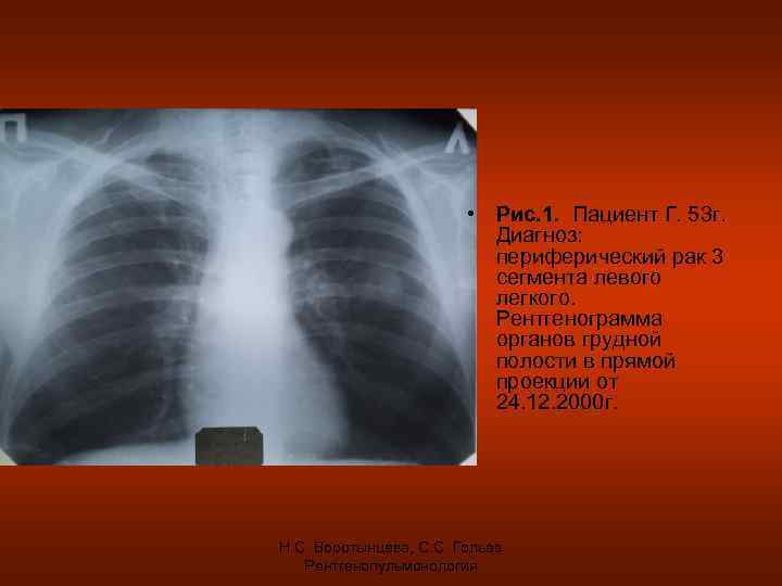  • Рис. 1. Пациент Г. 53 г. Диагноз: периферический рак 3 сегмента левого