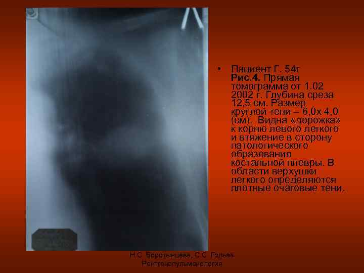  • Пациент Г. 54 г Рис. 4. Прямая томограмма от 1. 02 2002