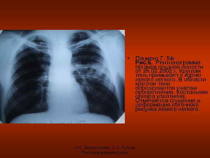  • Пациент Г. 54 г. Рис. 6. Рентгенограмма органов грудной полости от 26.