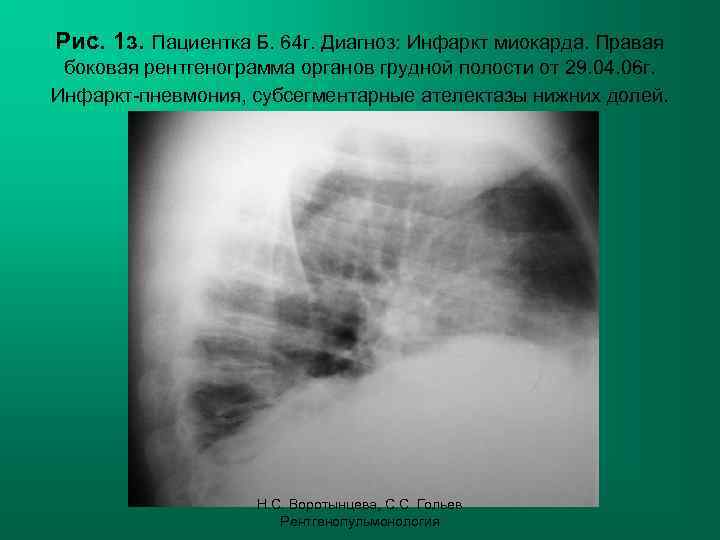 Рис. 1 з. Пациентка Б. 64 г. Диагноз: Инфаркт миокарда. Правая боковая рентгенограмма органов
