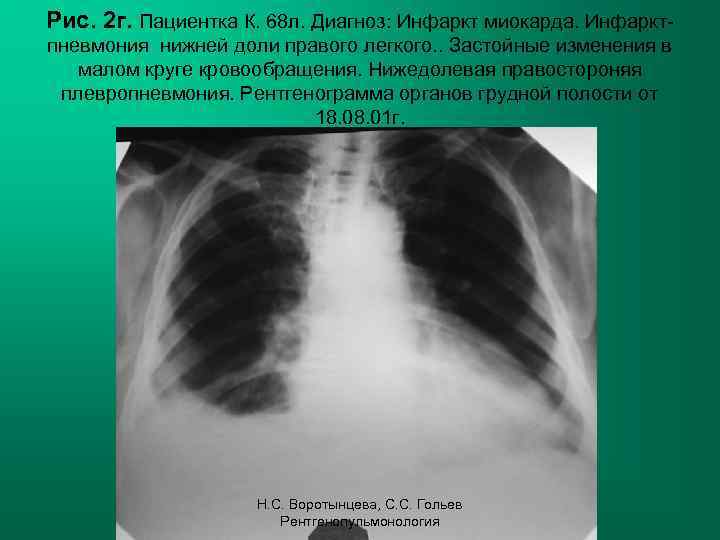 Рис. 2 г. Пациентка К. 68 л. Диагноз: Инфаркт миокарда. Инфарктпневмония нижней доли правого