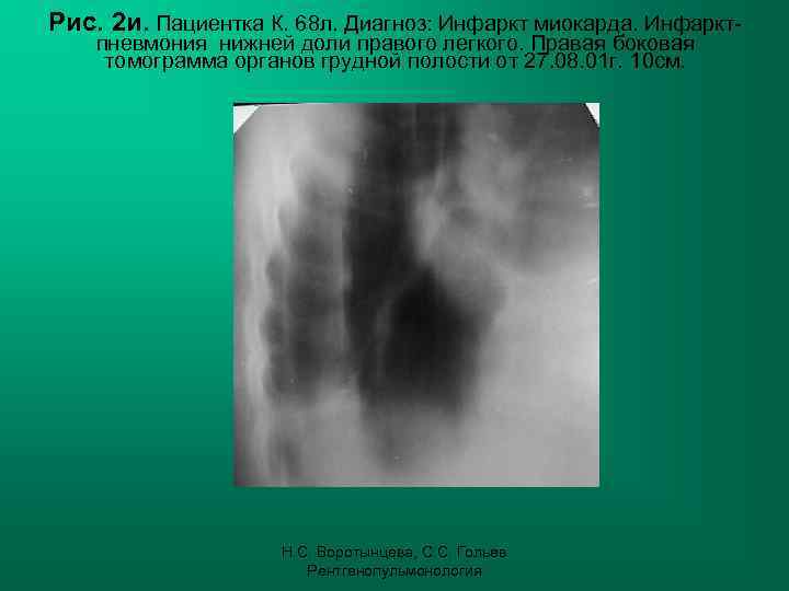 Рис. 2 и. Пациентка К. 68 л. Диагноз: Инфаркт миокарда. Инфарктпневмония нижней доли правого