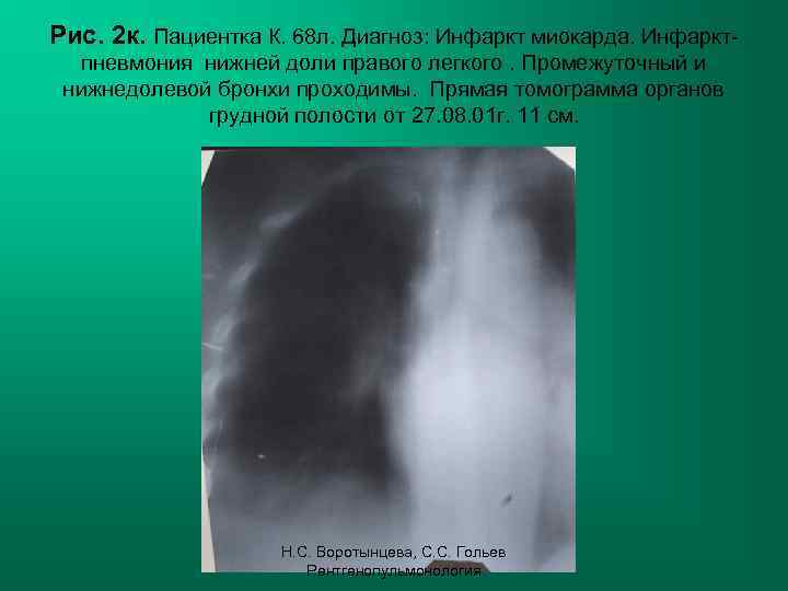 Рис. 2 к. Пациентка К. 68 л. Диагноз: Инфаркт миокарда. Инфарктпневмония нижней доли правого