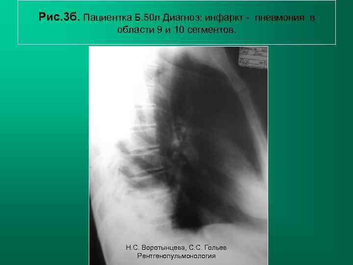 Рис. 3 б. Пациентка Б. 50 л Диагноз: инфаркт - пневмония в области 9