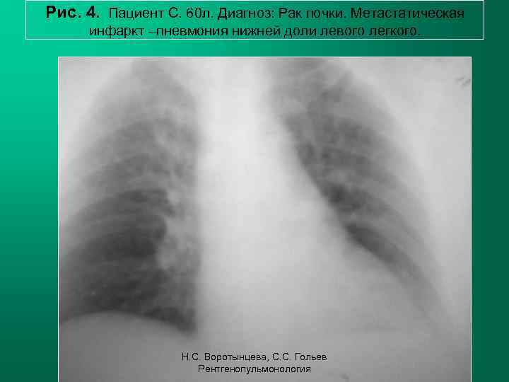 Рис. 4. Пациент С. 60 л. Диагноз: Рак почки. Метастатическая инфаркт –пневмония нижней доли