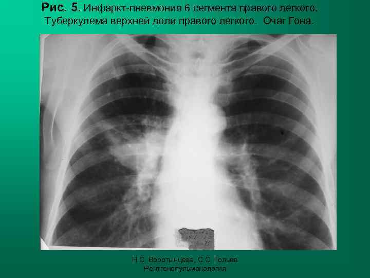 Рис. 5. Инфаркт-пневмония 6 сегмента правого легкого. Туберкулема верхней доли правого легкого. Очаг Гона.
