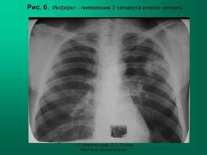 Рис. 6. Инфаркт - пневмония 3 сегмента левого легкого. Н. С. Воротынцева, С. С.
