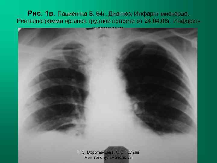Рис. 1 в. Пациентка Б. 64 г. Диагноз: Инфаркт миокарда. Рентгенограмма органов грудной полости