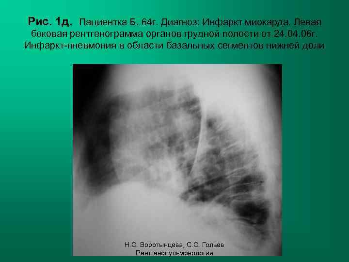 Рис. 1 д. Пациентка Б. 64 г. Диагноз: Инфаркт миокарда. Левая боковая рентгенограмма органов