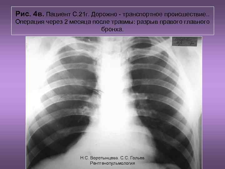 Рис. 4 в. Пациент С. 21 г. Дорожно - транспортное происшествие. . Операция через