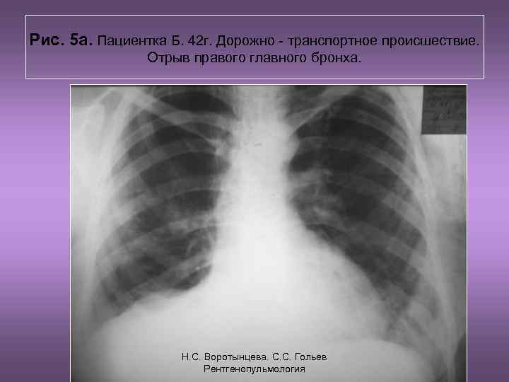 Рис. 5 а. Пациентка Б. 42 г. Дорожно - транспортное происшествие. Отрыв правого главного