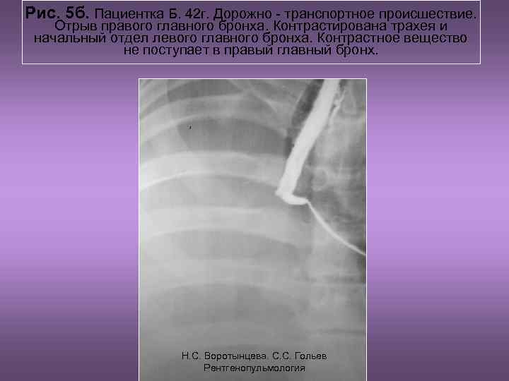 Рис. 5 б. Пациентка Б. 42 г. Дорожно - транспортное происшествие. Отрыв правого главного