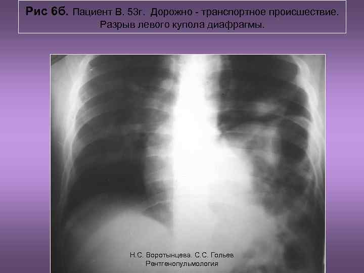 Рис 6 б. Пациент В. 53 г. Дорожно - транспортное происшествие. Разрыв левого купола