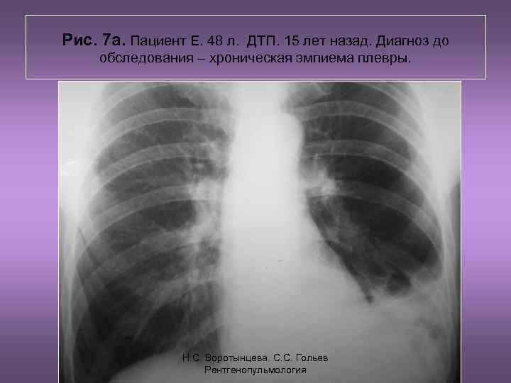 Рис. 7 а. Пациент Е. 48 л. ДТП. 15 лет назад. Диагноз до обследования