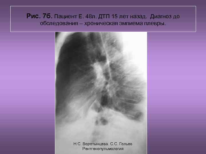 Рис. 7 б. Пациент Е. 48 л. ДТП 15 лет назад. Диагноз до обследования