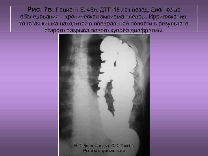 Рис. 7 в. Пациент Е. 48 л. ДТП 15 лет назад. Диагноз до обследования