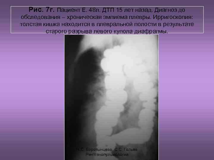 Рис. 7 г. Пациент Е. 48 л. ДТП 15 лет назад. Диагноз до обследования
