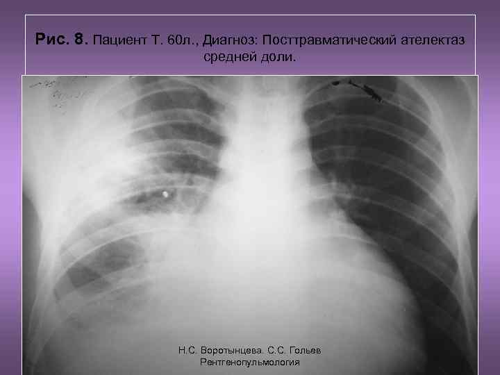 Рис. 8. Пациент Т. 60 л. , Диагноз: Посттравматический ателектаз средней доли. Н. С.