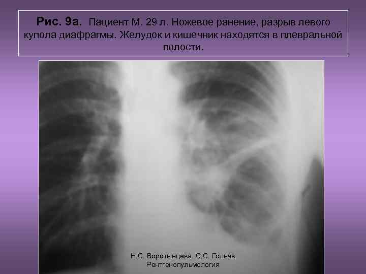 Рис. 9 а. Пациент М. 29 л. Ножевое ранение, разрыв левого купола диафрагмы. Желудок