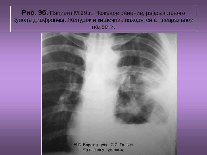 Рис. 9 б. Пациент М. 29 л. Ножевое ранение, разрыв левого купола диафрагмы. Желудок
