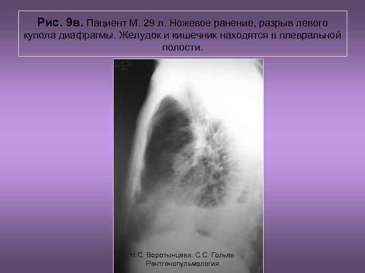 Рис. 9 в. Пациент М. 29 л. Ножевое ранение, разрыв левого купола диафрагмы. Желудок
