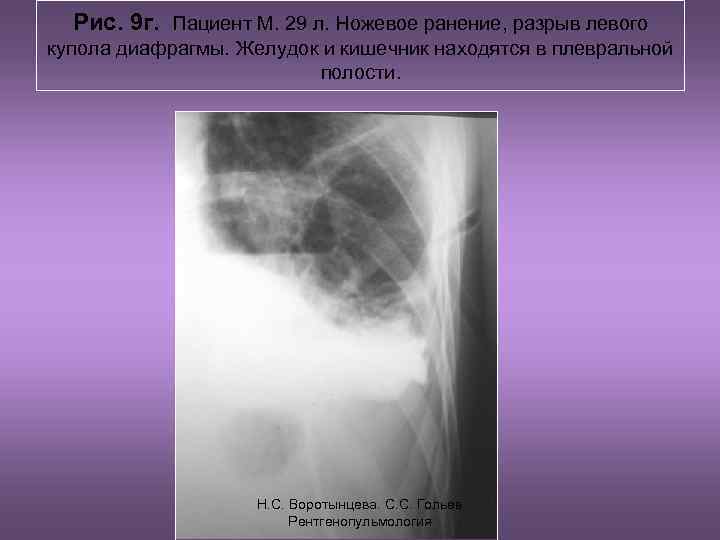 Рис. 9 г. Пациент М. 29 л. Ножевое ранение, разрыв левого купола диафрагмы. Желудок