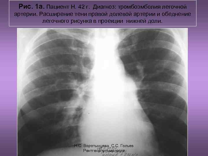 Рис. 1 а. Пациент Н. 42 г. Диагноз: тромбоэмболия легочной артерии. Расширение тени правой
