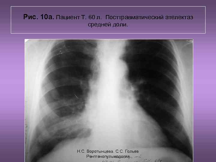 Рис. 10 а. Пациент Т. 60 л. Посттравматический ателектаз средней доли. Н. С. Воротынцева.
