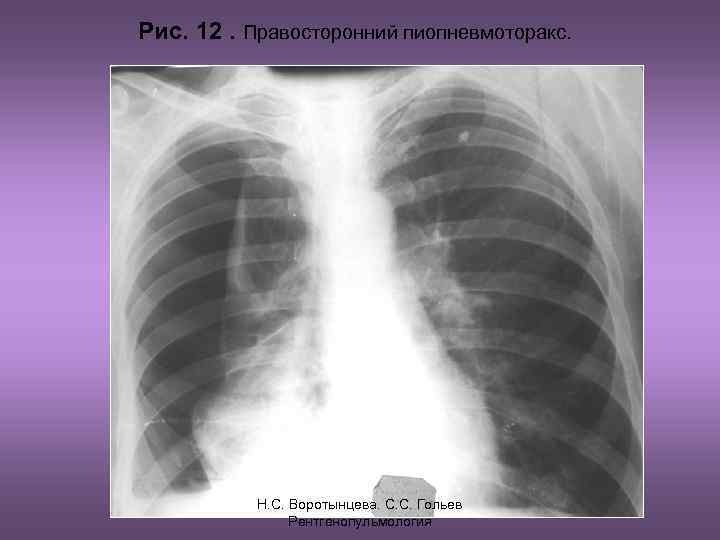 Рис. 12. Правосторонний пиопневмоторакс. Н. С. Воротынцева. С. С. Гольев Рентгенопульмология 