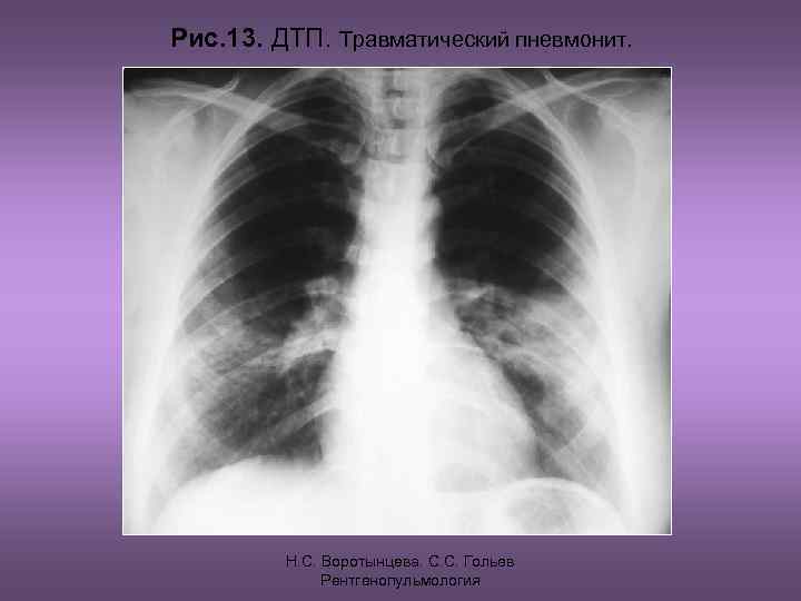 Рис. 13. ДТП. Травматический пневмонит. Н. С. Воротынцева. С. С. Гольев Рентгенопульмология 