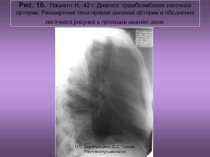 Рис. 1 б. Пациент Н. 42 г. Диагноз: тромбоэмболия легочной артерии. Расширение тени правой