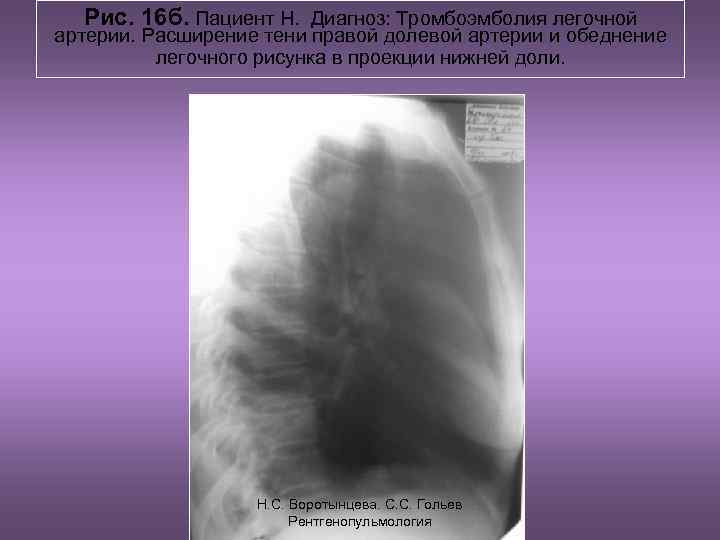 Рис. 16 б. Пациент Н. Диагноз: Тромбоэмболия легочной артерии. Расширение тени правой долевой артерии