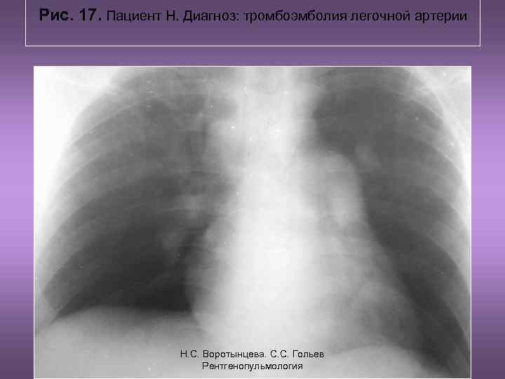 Рис. 17. Пациент Н. Диагноз: тромбоэмболия легочной артерии Н. С. Воротынцева. С. С. Гольев