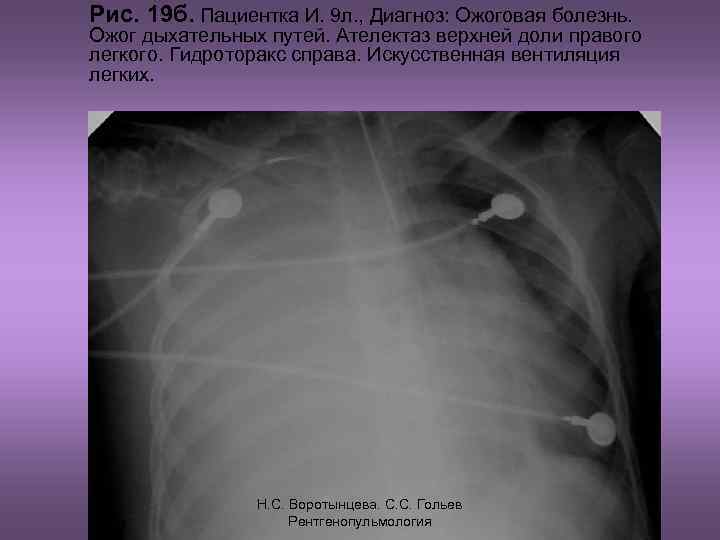 Рис. 19 б. Пациентка И. 9 л. , Диагноз: Ожоговая болезнь. Ожог дыхательных путей.