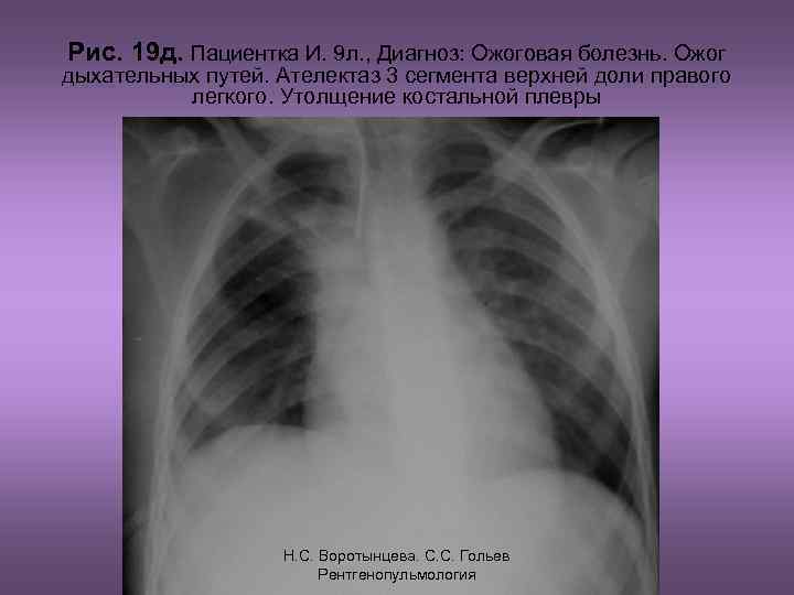 Рис. 19 д. Пациентка И. 9 л. , Диагноз: Ожоговая болезнь. Ожог дыхательных путей.