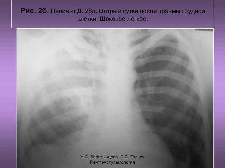 Рис. 2 б. Пациент Д. 28 л. Вторые сутки после травмы грудной клетки. Шоковое