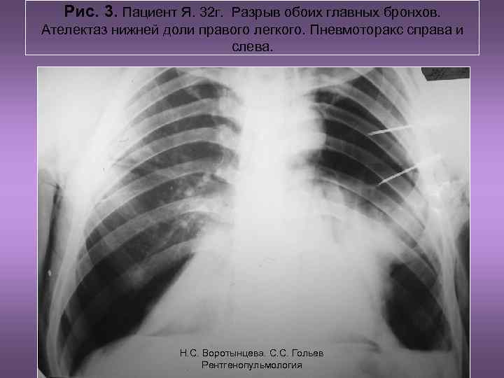 Рис. 3. Пациент Я. 32 г. Разрыв обоих главных бронхов. Ателектаз нижней доли правого