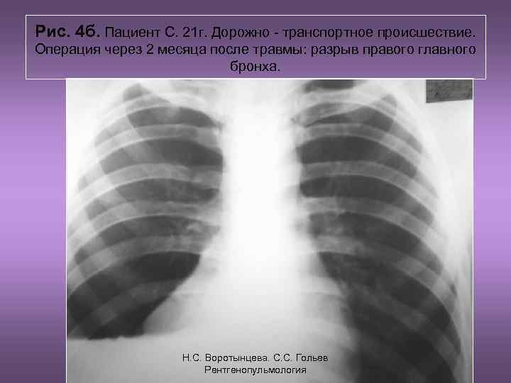 Рис. 4 б. Пациент С. 21 г. Дорожно - транспортное происшествие. Операция через 2