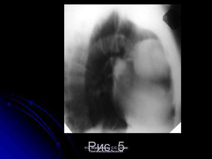 Рис. 5 Н. С. Воротынцева. С. С. Гольев Рентгенопульмонология 