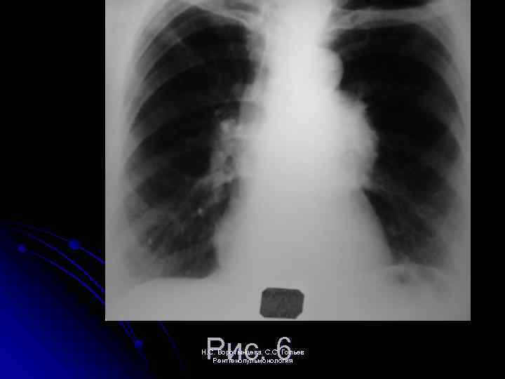 Рис. 6 Н. С. Воротынцева. С. С. Гольев Рентгенопульмонология 