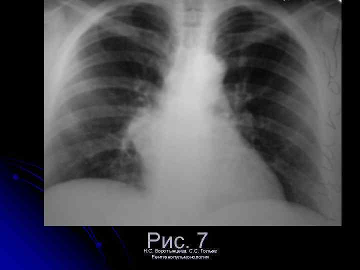 Рис. 7 Н. С. Воротынцева. С. С. Гольев Рентгенопульмонология 