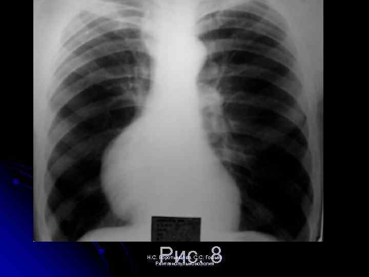 Рис. 8 Н. С. Воротынцева. С. С. Гольев Рентгенопульмонология 