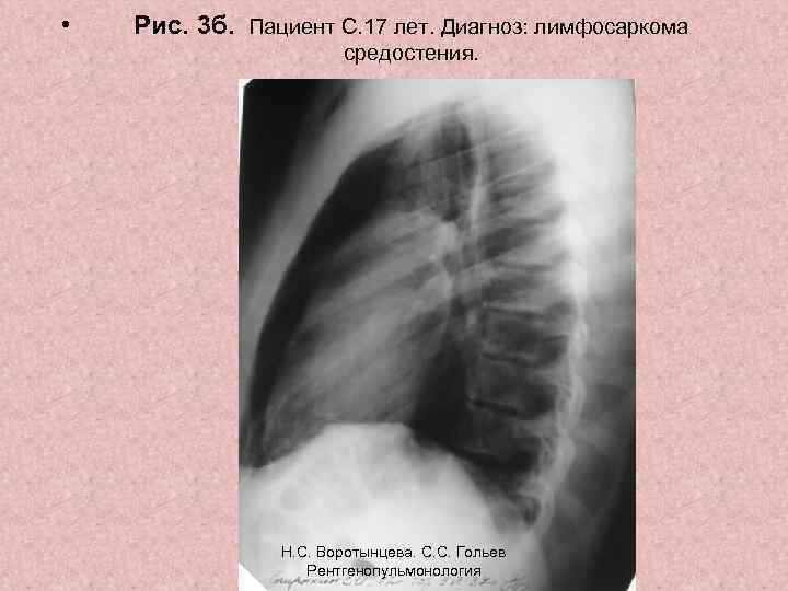  • Рис. 3 б. Пациент С. 17 лет. Диагноз: лимфосаркома средостения. Н. С.