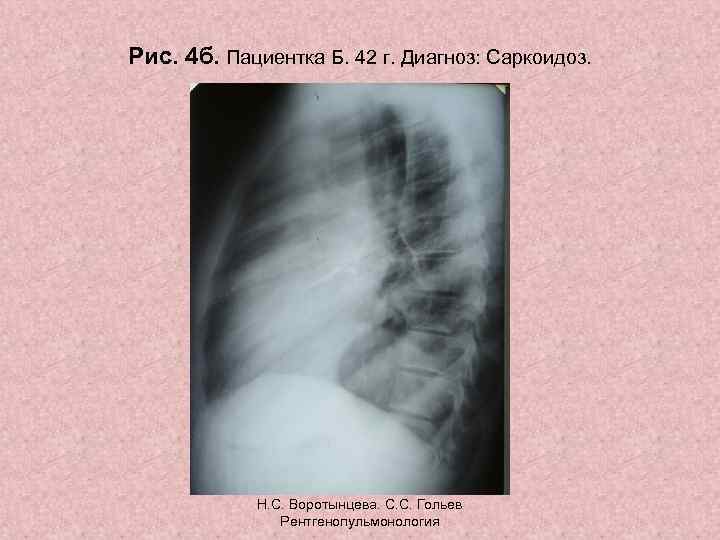 Рис. 4 б. Пациентка Б. 42 г. Диагноз: Саркоидоз. Н. С. Воротынцева. С. С.