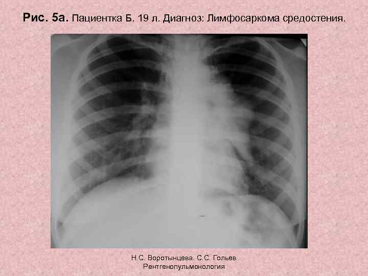 Рис. 5 а. Пациентка Б. 19 л. Диагноз: Лимфосаркома средостения. Н. С. Воротынцева. С.