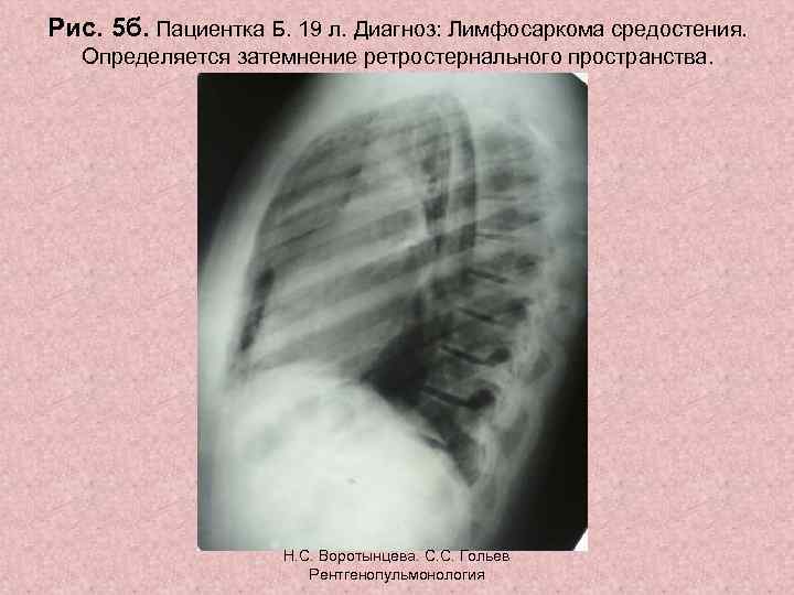 Рис. 5 б. Пациентка Б. 19 л. Диагноз: Лимфосаркома средостения. Определяется затемнение ретростернального пространства.