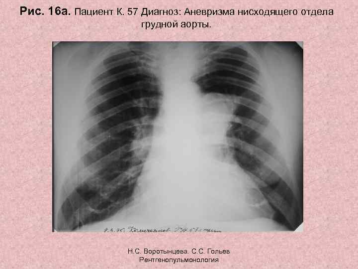 Рис. 16 а. Пациент К. 57 Диагноз: Аневризма нисходящего отдела грудной аорты. Н. С.