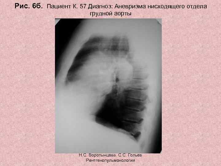 Рис. 6 б. Пациент К. 57 Диагноз: Аневризма нисходящего отдела грудной аорты Н. С.